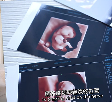 恭喜二胎生女!孩子染色体异常,智力恐有缺陷,今身体健康终于放心(组图) - 15