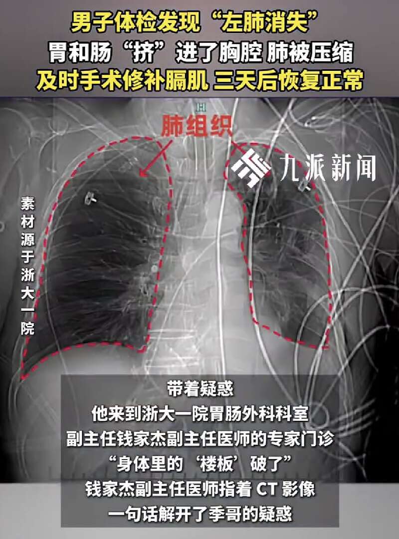 男子中奖获体检,发现左肺不见了,无明显不适(组图) - 1