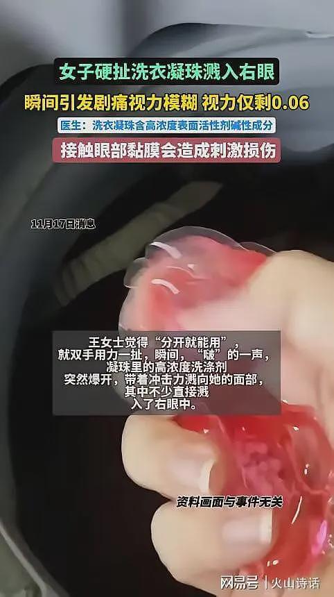 恐怖!洗衣引发“爆炸”,杭州一女子撕扯凝珠发生意外致眼睛失明(组图) - 2