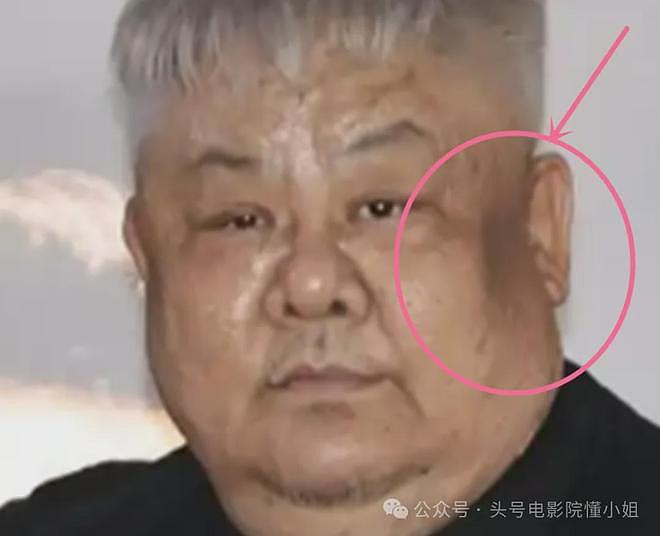 男星林雪辟谣欠债百亿,网友却发现他脸上黑斑变大,面积扩大3倍(组图) - 11