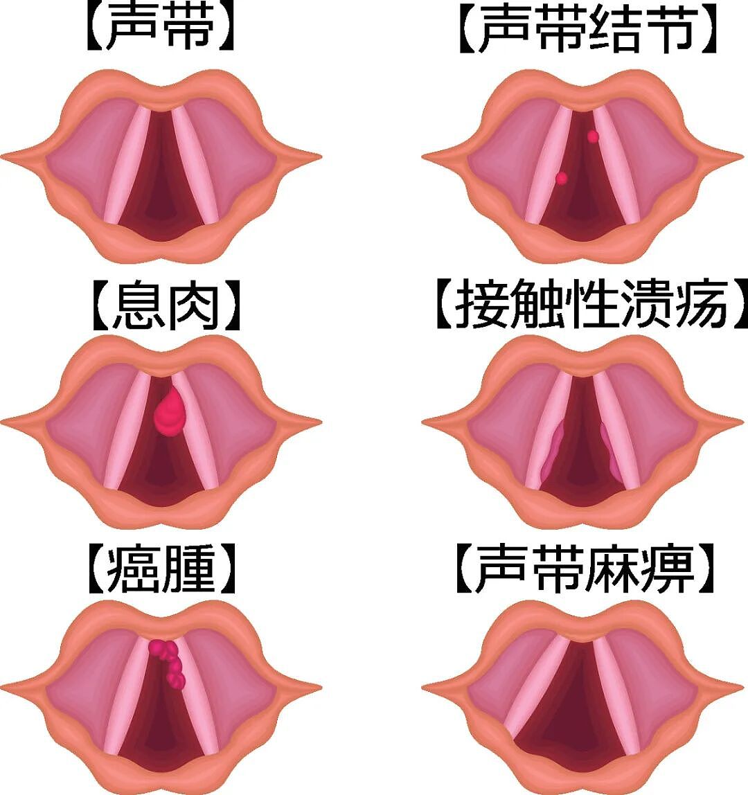 这些位置长了息肉，一定要当心！尤其这种几乎 100% 会癌变（组图） - 4