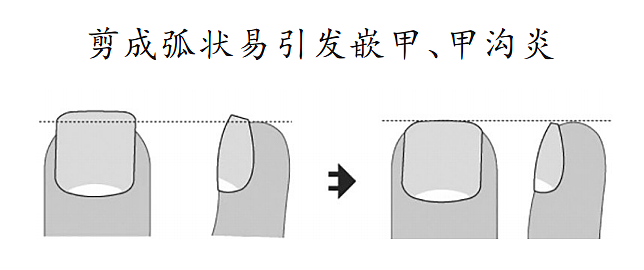 指甲长出黑线,符合这几种特征可能癌变(组图) - 13