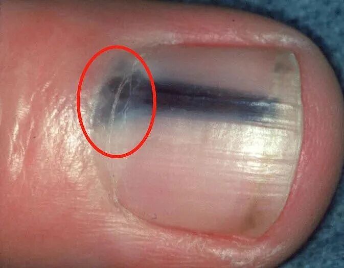 指甲长出黑线,符合这几种特征可能癌变(组图) - 9