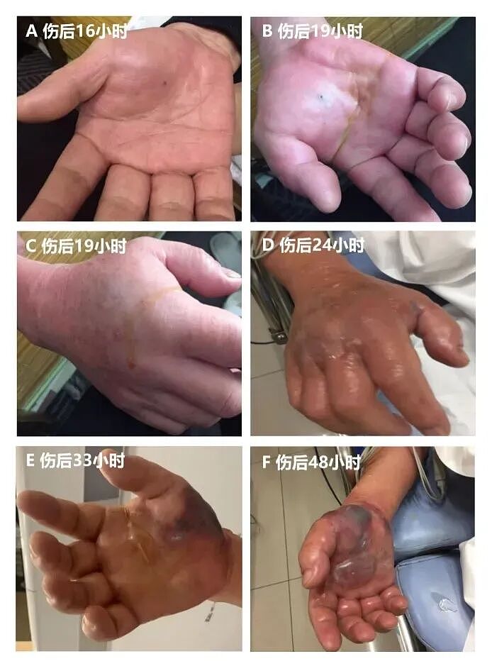 一男子处理海鲜时不小心被扎伤，几天后突然去世！处理海鲜的致命雷区，很多人不知道（组图） - 5
