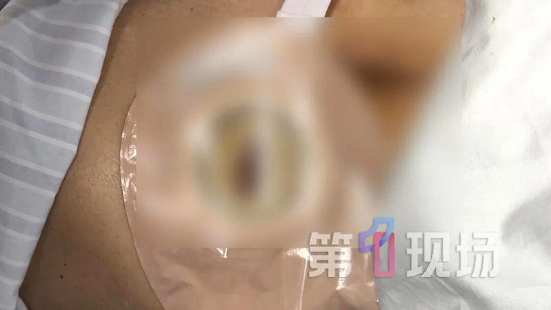 广州男便秘十多天后，口腔喷出粪便！医生：再晚一天就惨了（组图） - 2