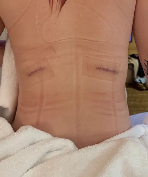 28岁美国女子为“终极腰线”，花近10万元切除六根肋骨，后悔不已（组图） - 4
