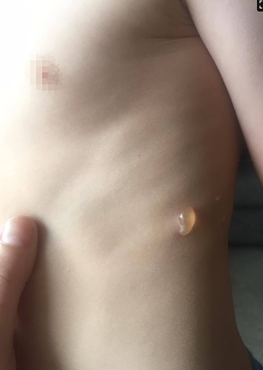 水泡、红斑！新西兰华人被这种虫“咬惨了”！夏季集体出窝，杀伤力强，接触瞬间堪比中电...（组图） - 5