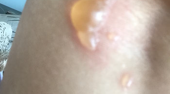 水泡、红斑！新西兰华人被这种虫“咬惨了”！夏季集体出窝，杀伤力强，接触瞬间堪比中电...（组图） - 4