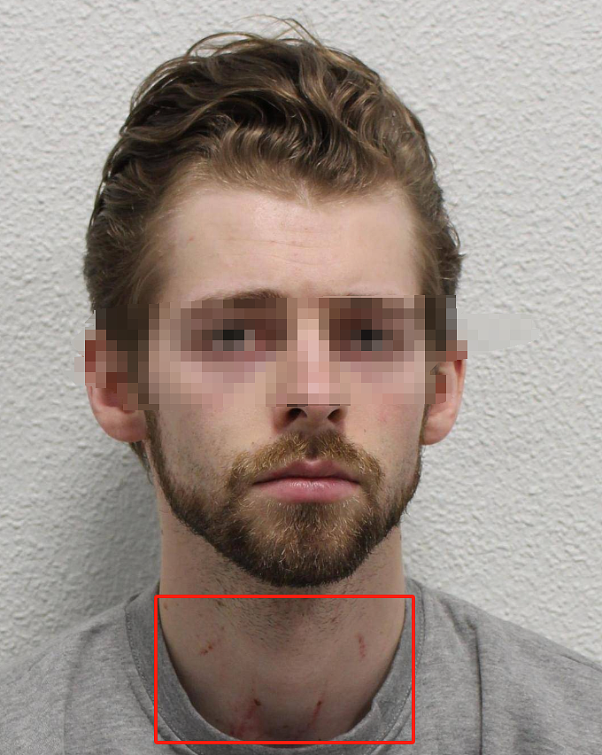 名校女生怀疑被男友传染性病后被男友杀害，这脖子上的红斑太可怕…（组图） - 4