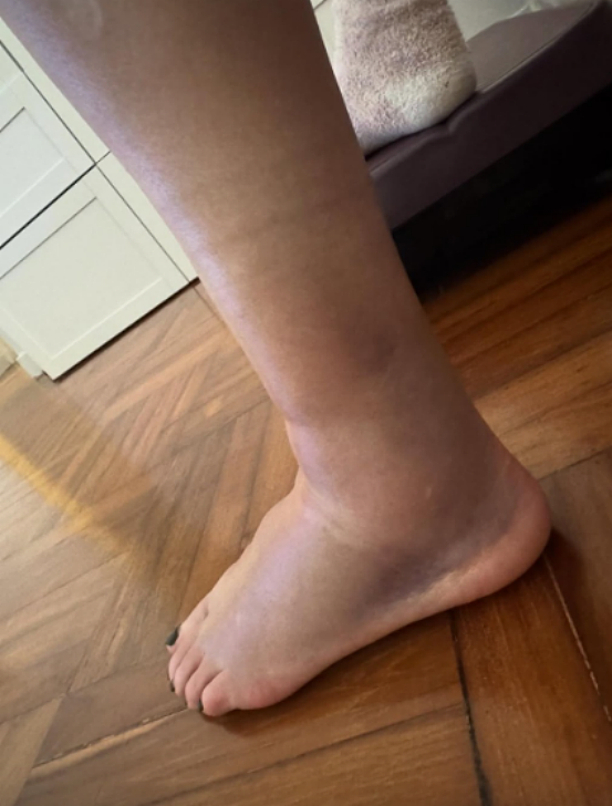 香港知名女星发生意外，左脚骨裂肿起来很高，曾与周润发闪婚闪离（组图） - 3