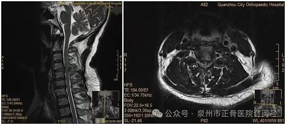 女子夜里翻身拿手机突然瘫痪！19 岁小伙长时间低头高位瘫痪！这些症状，切勿掉以轻心（组图） - 1