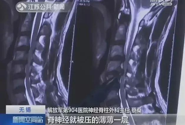 女子夜里翻身拿手机突然瘫痪！19 岁小伙长时间低头高位瘫痪！这些症状，切勿掉以轻心（组图） - 3