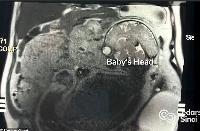 肚子囊肿突然变大，竟是因为后面藏了个娃？女子宫外孕怀到足月，母子平安，简直奇迹！（组图） - 3