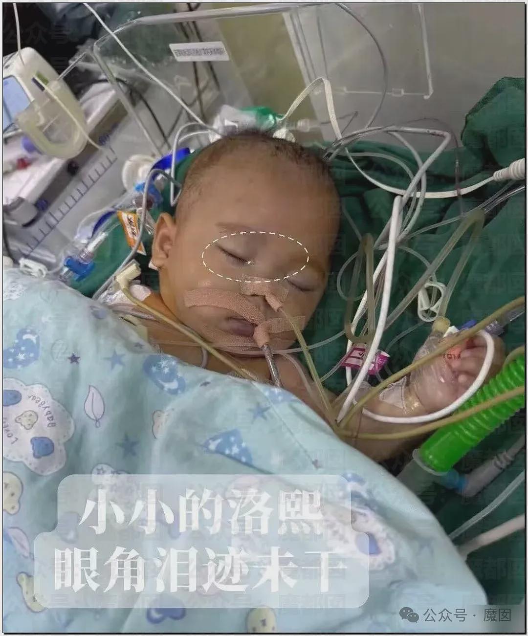 5个月婴儿做争议开胸术后去世，已有多个孩子殒命！全网为小洛熙讨说法（组图） - 16