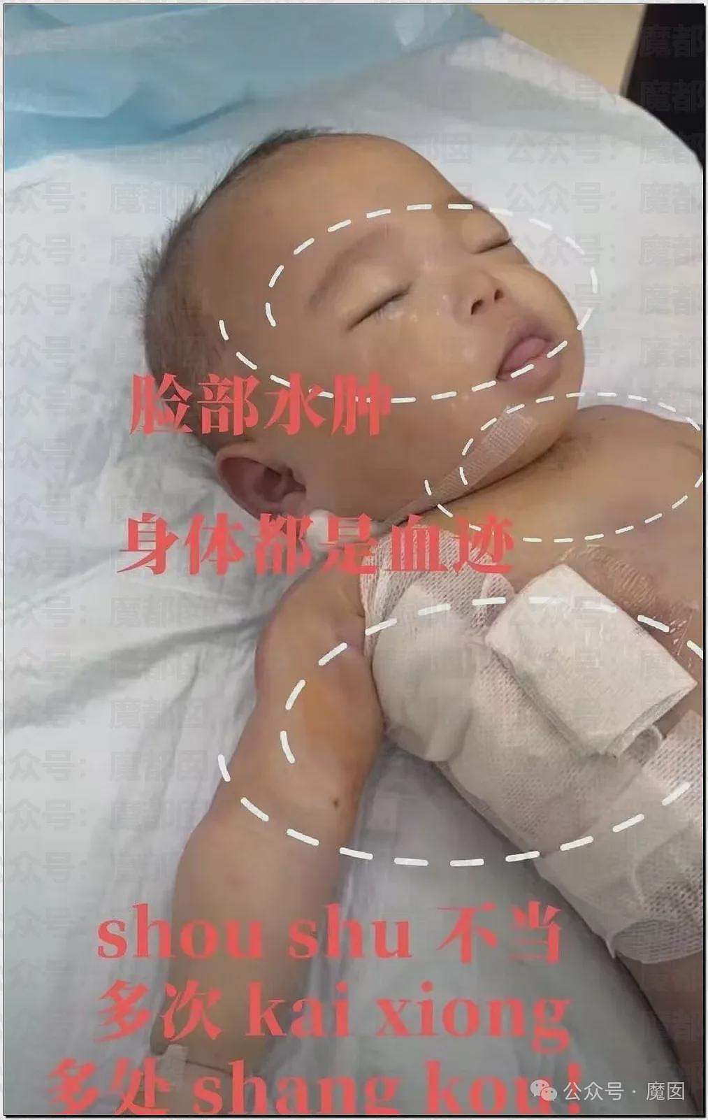 5个月婴儿做争议开胸术后去世，已有多个孩子殒命！全网为小洛熙讨说法（组图） - 6