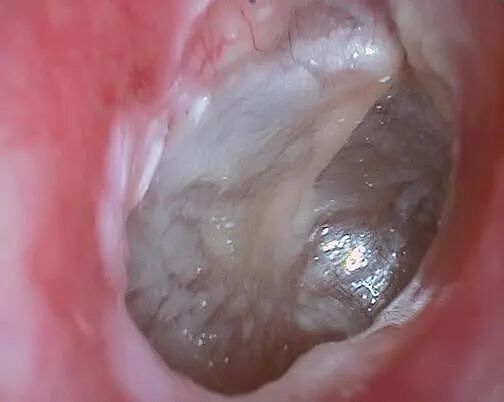 耳朵总是痒，却啥也掏不出来？可能暗示这5种问题，快自查（组图） - 6