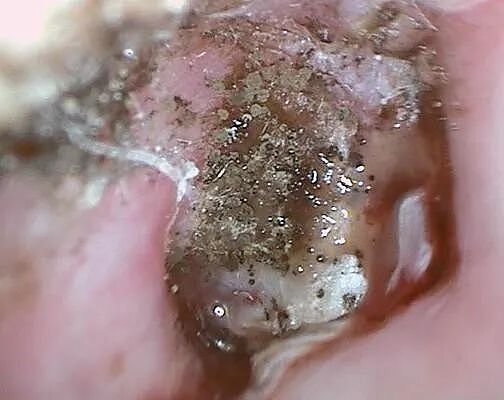 耳朵总是痒，却啥也掏不出来？可能暗示这5种问题，快自查（组图） - 4