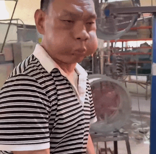 工作太不容易,男子面部严重变形!自嘲“青蛙王子”...这些都是职业病(组图) - 3