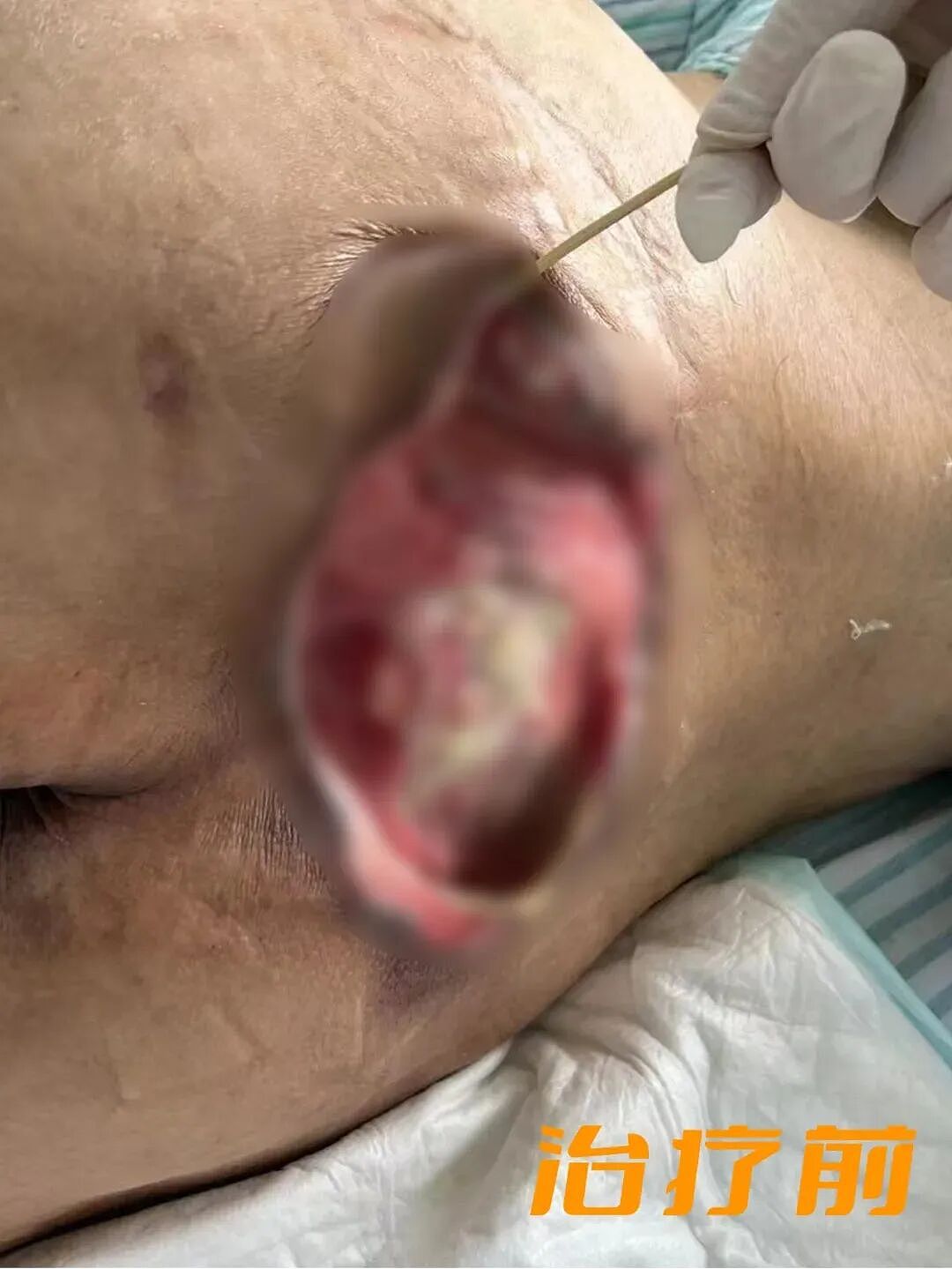 一觉醒来,21岁女生的屁股惨不忍睹!这件事不能超6小时,严重或危及生命(组图) - 3