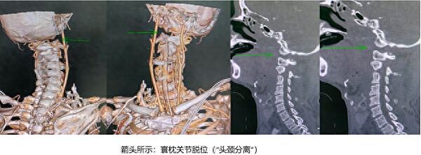 大陆老翁“头颈分离”,医生用妙招救回:能活著到医院就是奇迹(组图) - 1