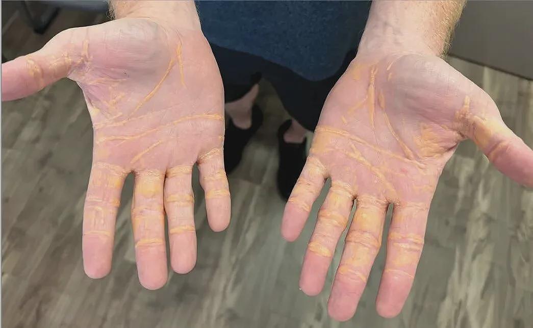 菜刀插进胸膛8年竟浑然不知，这位狠人震惊医学界（组图） - 6