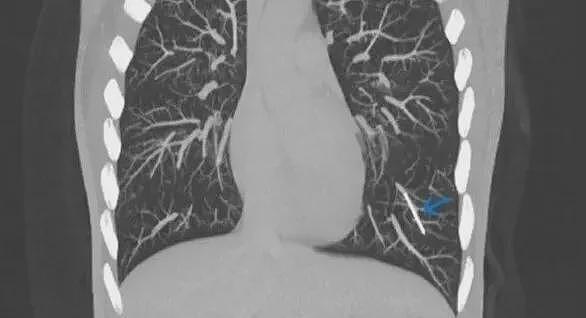 菜刀插进胸膛8年竟浑然不知，这位狠人震惊医学界（组图） - 10