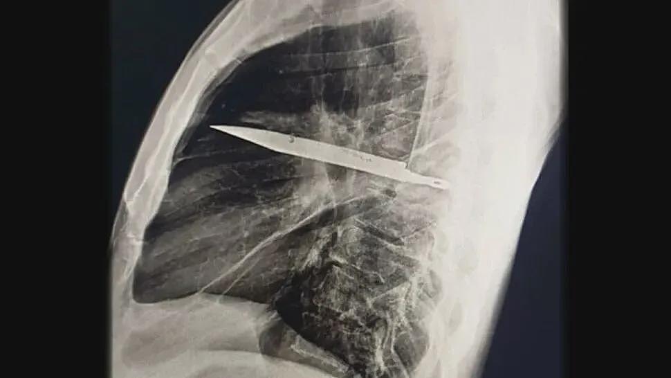 菜刀插进胸膛8年竟浑然不知，这位狠人震惊医学界（组图） - 3