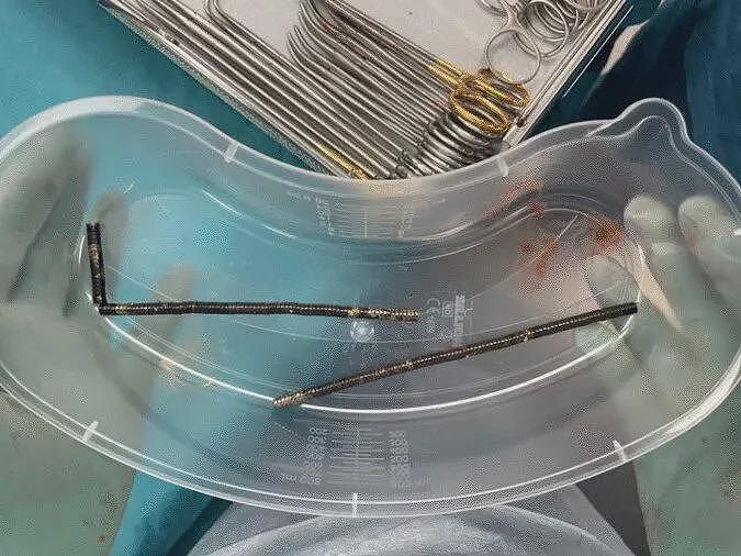 菜刀插进胸膛8年竟浑然不知，这位狠人震惊医学界（组图） - 2