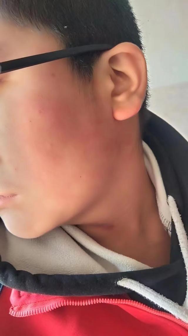 13岁男孩遭老师掌掴致眼睛九级伤残，法院判校方赔70.6万元，护理费另诉（组图） - 1