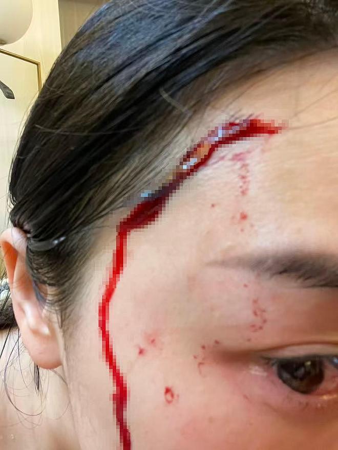 女子洗澡时浴室玻璃突然自爆致受伤,开发商:已超质保期,会妥善回应业主诉求(组图) - 2