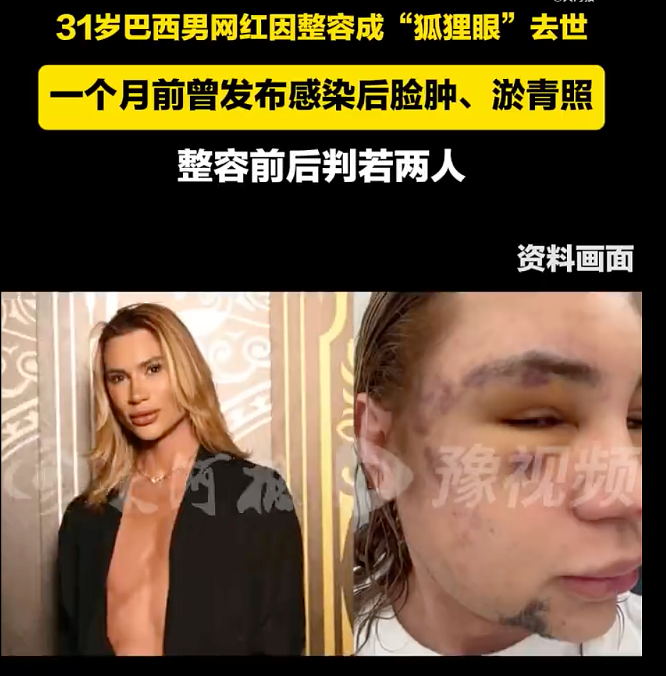 沉迷整形，把胸隆炸的网红突然过世？死时已整成外星人，网友怀疑自杀...（组图） - 10