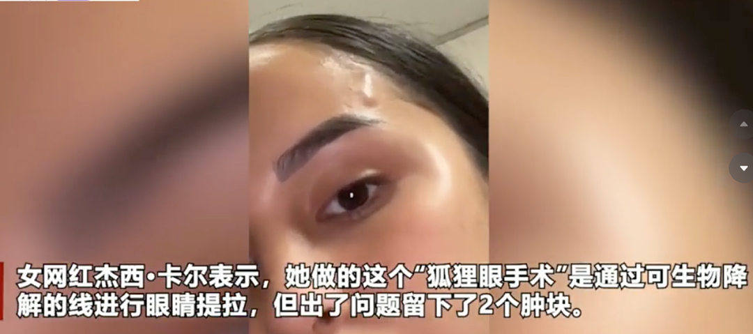 沉迷整形，把胸隆炸的网红突然过世？死时已整成外星人，网友怀疑自杀...（组图） - 9