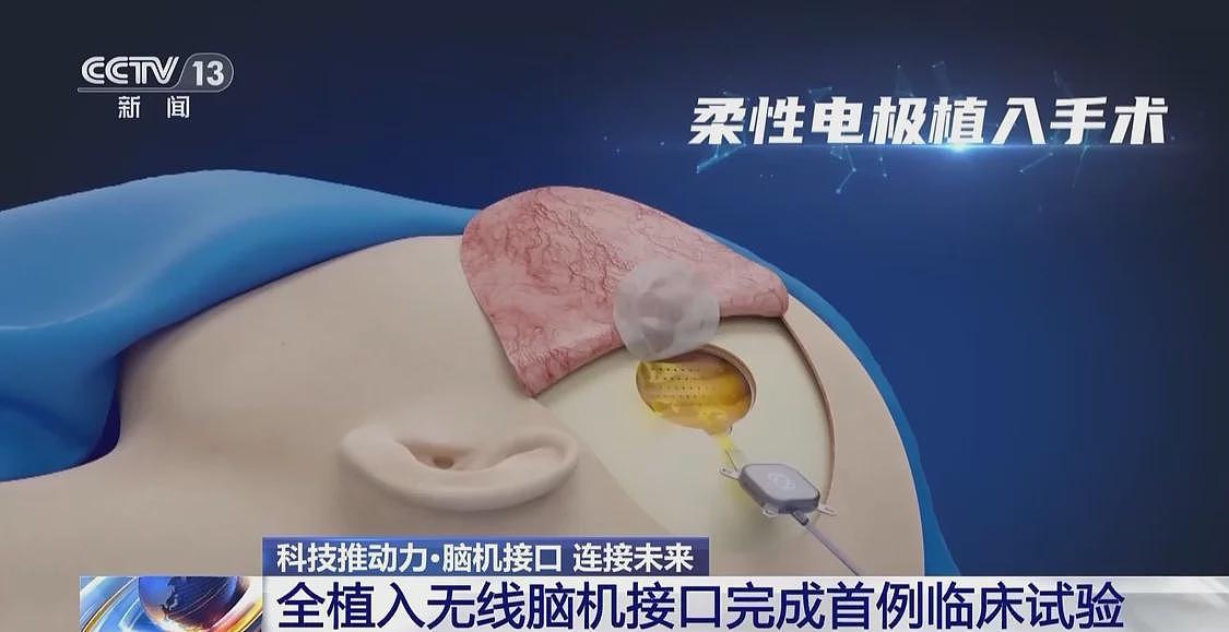 当脑机接口走入生活，会为我们带来哪些新可能？（组图） - 2