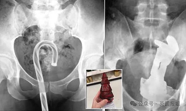 美肛肠科曝“菊花塞物白皮书”！炮弹、仓鼠、保温杯全进去了？（组图） - 7