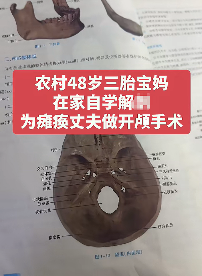 宝妈自学开颅手术生三胎，还要自己接生第五胎，看完她操作步骤网友吓哭（组图） - 2