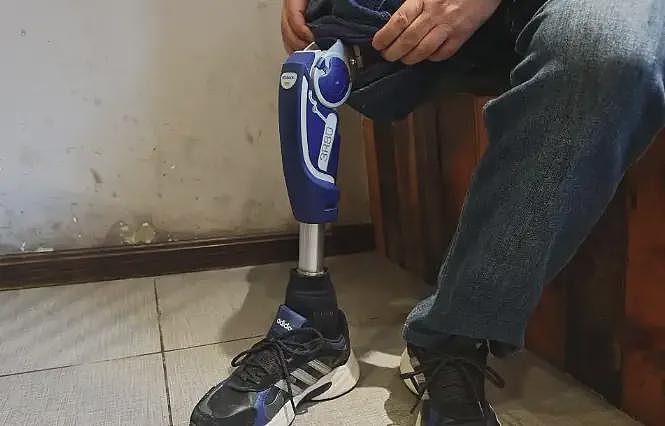 男子术后截肢状告医院二审胜诉，医院被判赔80余万（组图） - 2