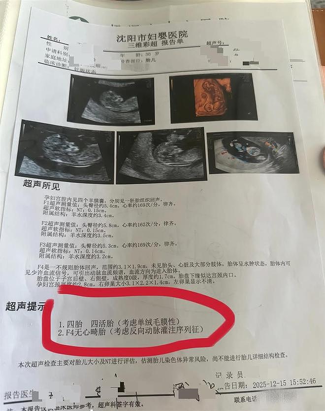 孕妇每次产检都发现多出一胎，医生：是罕见同卵四胞胎（组图） - 4