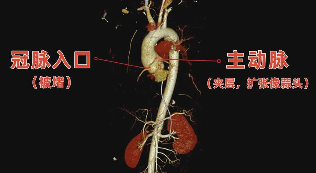 崩溃！与妻子争吵后，血管从胸口撕裂到腿部！长度近40厘米…（组图） - 5