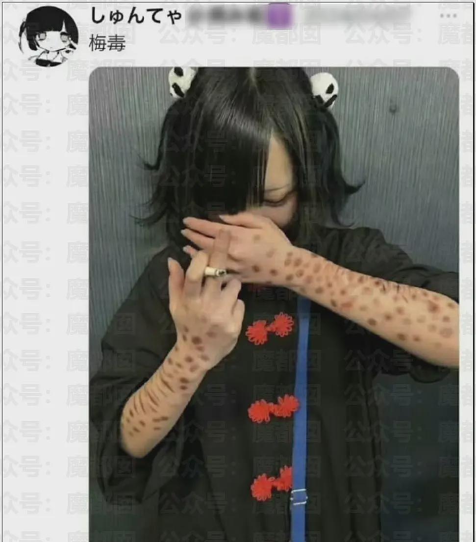 日本年轻人热衷梅毒文化震碎三观，还自残“模拟”病状（组图） - 5