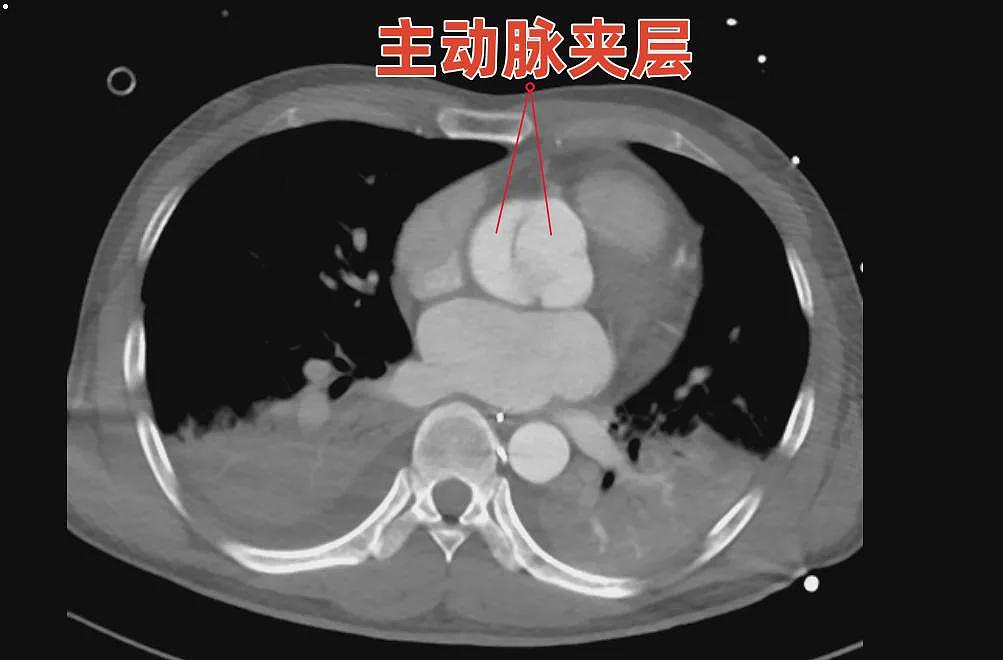 崩溃！与妻子争吵后，血管从胸口撕裂到腿部！长度近40厘米…（组图） - 2