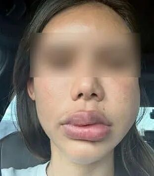 女子被忽悠打玻尿酸,结果嘴肿成香肠,脸肿成面包!两年过去还没恢复...(组图) - 2