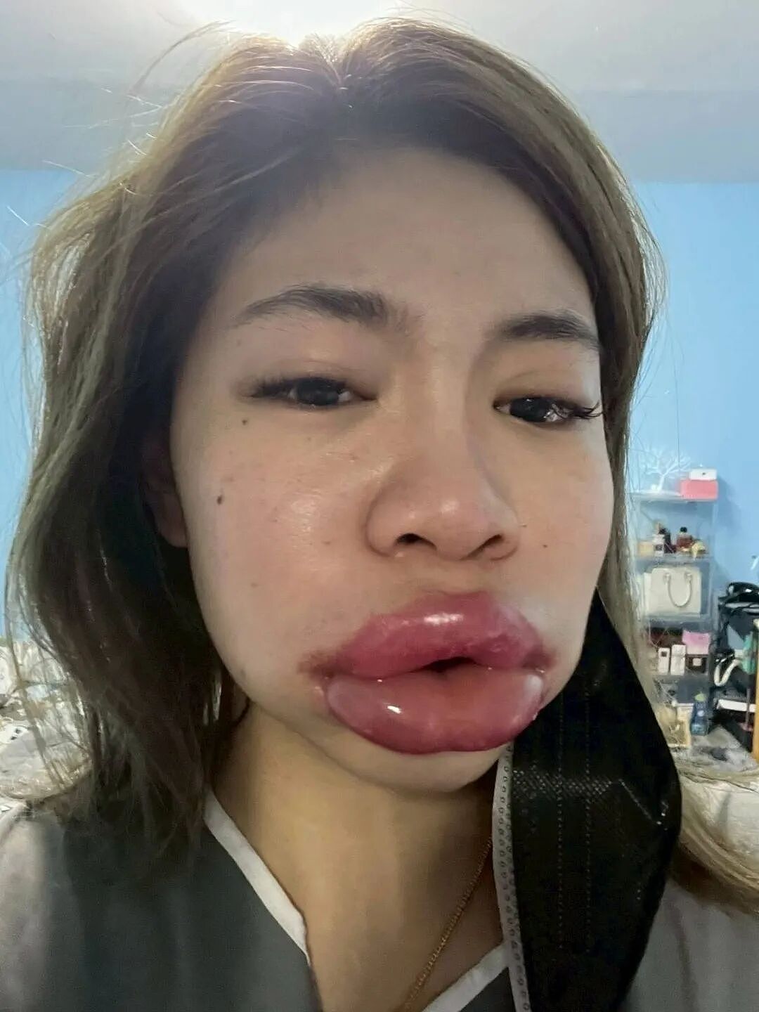 女子被忽悠打玻尿酸,结果嘴肿成香肠,脸肿成面包!两年过去还没恢复...(组图) - 4