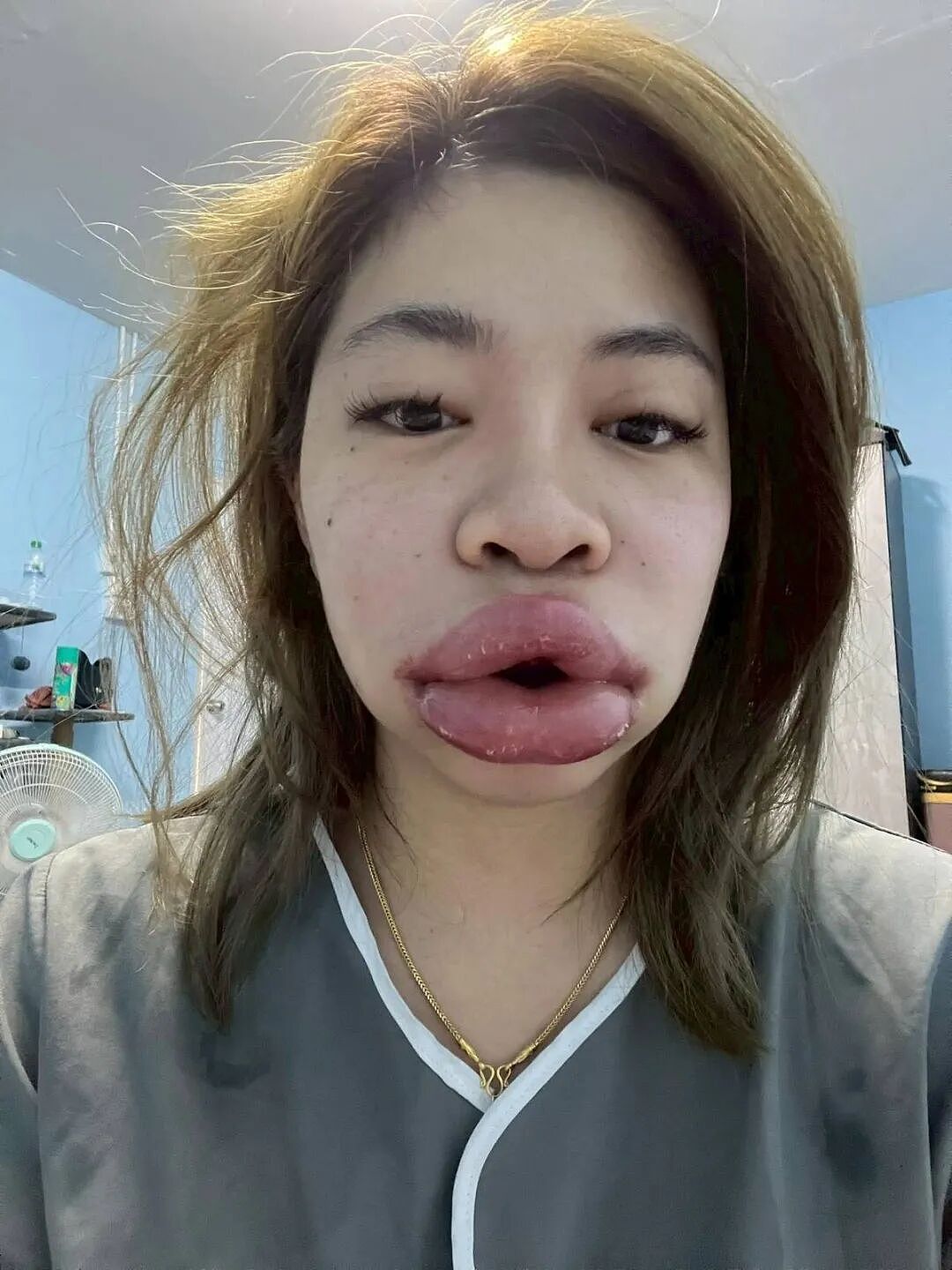 女子被忽悠打玻尿酸,结果嘴肿成香肠,脸肿成面包!两年过去还没恢复...(组图) - 5