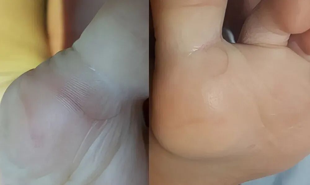 脖子上一条条的“黑道道”，是胰岛素抵抗吗？（组图） - 8