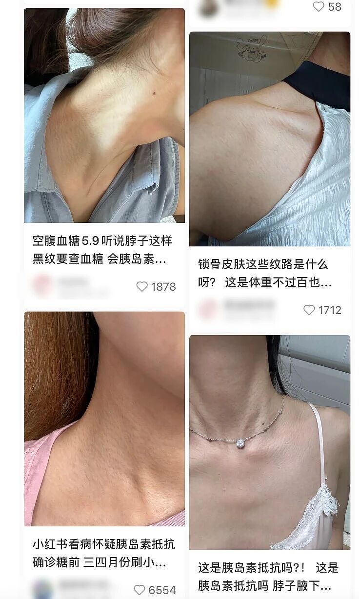 脖子上一条条的“黑道道”，是胰岛素抵抗吗？（组图） - 2
