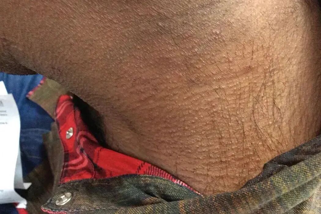 脖子上一条条的“黑道道”，是胰岛素抵抗吗？（组图） - 5