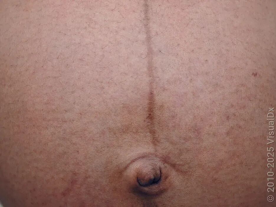 脖子上一条条的“黑道道”，是胰岛素抵抗吗？（组图） - 7