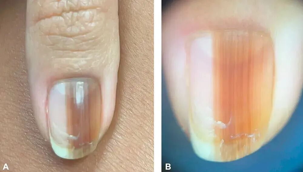 脖子上一条条的“黑道道”，是胰岛素抵抗吗？（组图） - 10