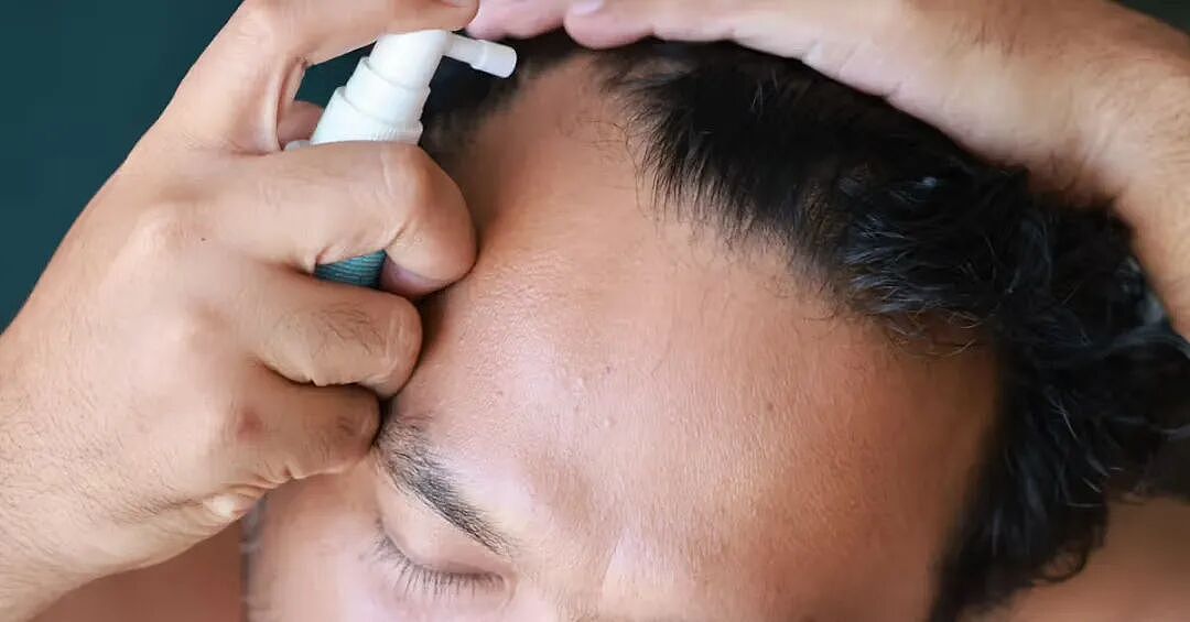 当心!澳男轻信 “脱发神药” ,结果萎了...(组图) - 2