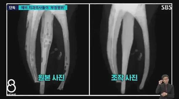 韩国顶尖大学医学生作弊，用PS修X光？！牙齿根管做坏了直接P成好的，网友炸了...（组图） - 2